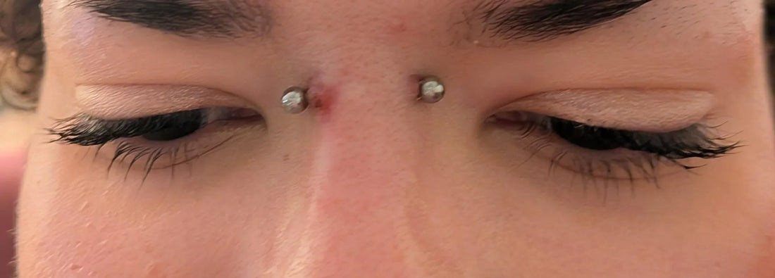 How to Get Rid of an Irritated Piercing Bump: Causes, Treatment & Prevention