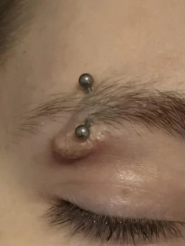Huge Bump on Eyebrow Piercing: Causes And Treatment