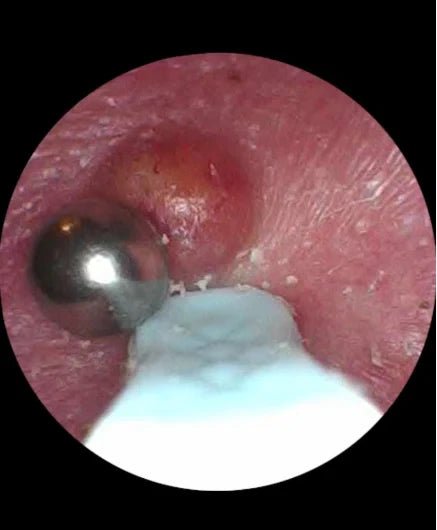 How to fast and safely Get Rid of a Keloid on Your Conch or Rook Piercing - QIAO Crystal